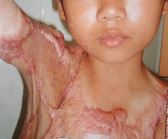 SẸO LỒI DO BỎNG NƯỚC SÔI